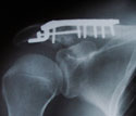 Click on the image to see the details oif this cool x-ray from Downhill Dave's shoulder :)