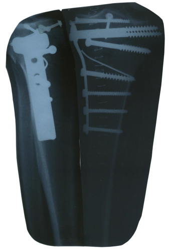 downhill dave's leg x-ray