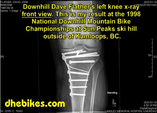 Click here for a larger x-ray of Downhill Dave Flather's left leg