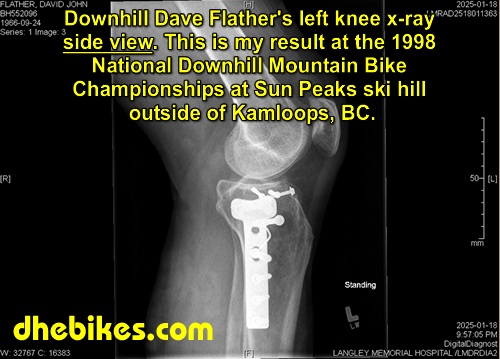 Click here for a larger x-ray of Downhill Dave Flather's left leg